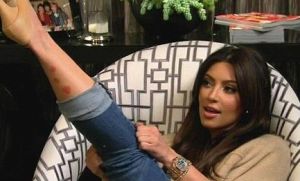 Kim Kardashian showing the Psoriasis on her leg